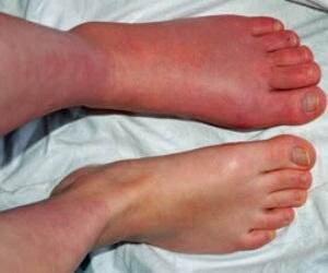 Thumbnail of topic : Complex Regional Pain Syndrome of Foot(CRPS) | Dr. Sampat Dumbre Patil